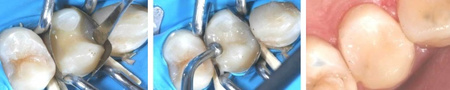 Formówki sekcyjne profilowane (op. 50 szt.) duże z krawędzią - 0.035mm hard (1.0974) - TOR VM